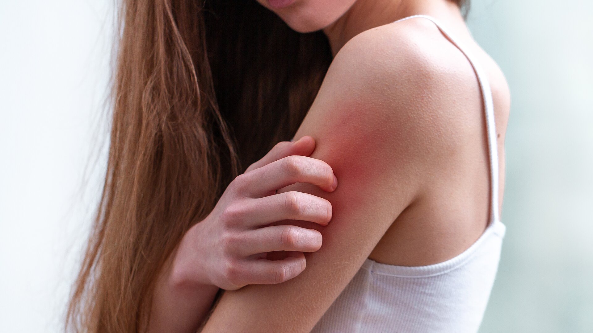 How to prevent and treat the most common summer skin woes