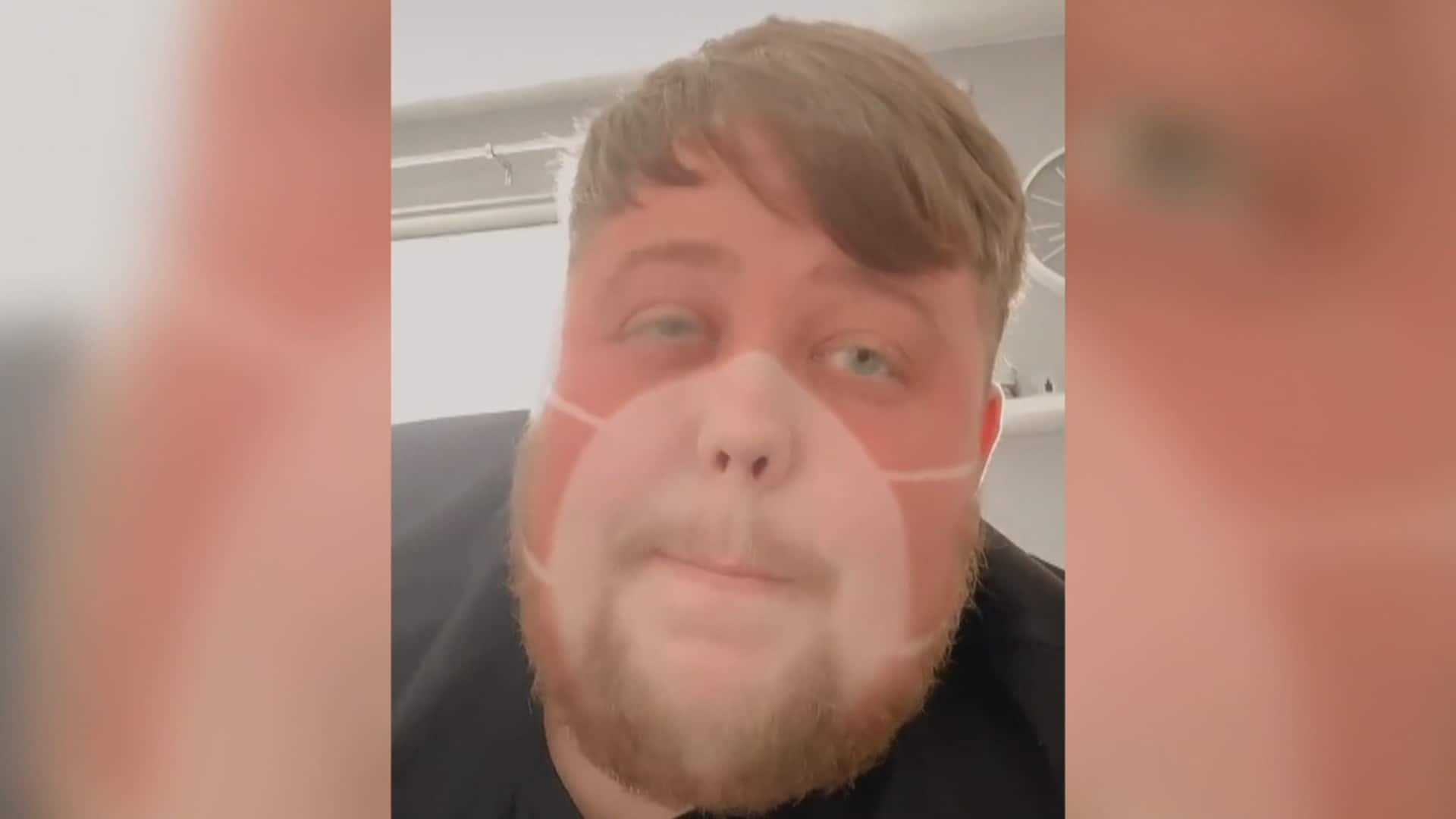 Man Posts Video Of Hilarious Face Mask Sunburn